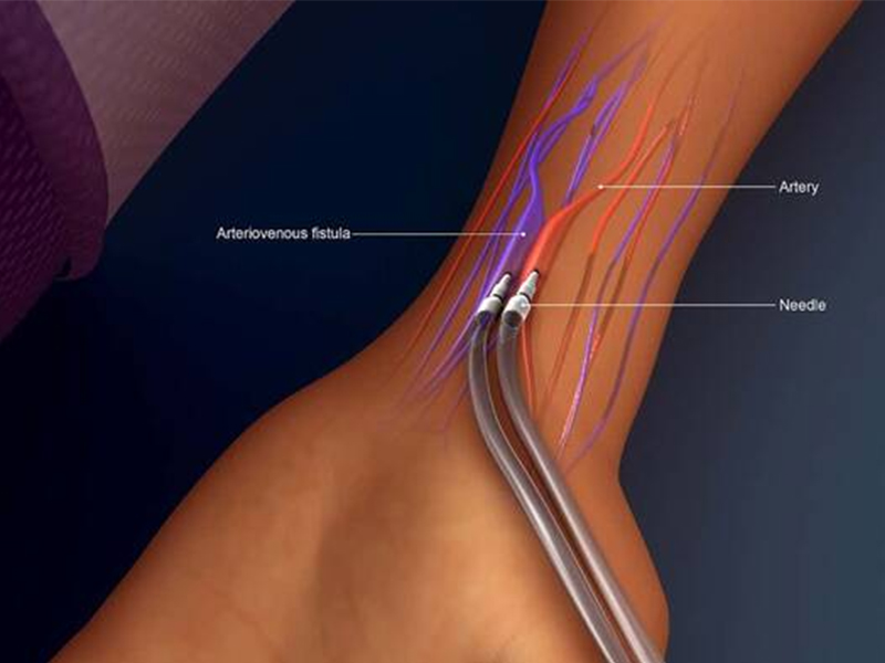 diagrama de cirugía de fistula venosa