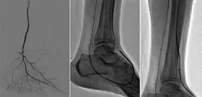 arteriografía venosa previa a la cirugía