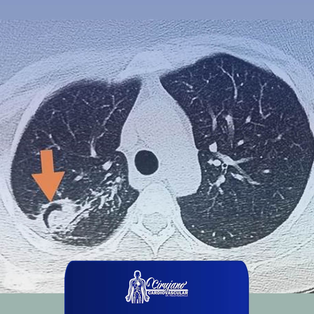 cirugía aspergiloma pulmonar