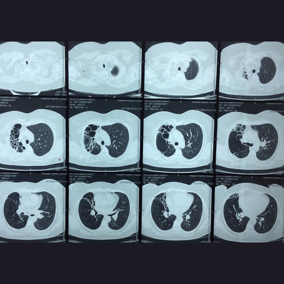 cirugía para bronquiectasia