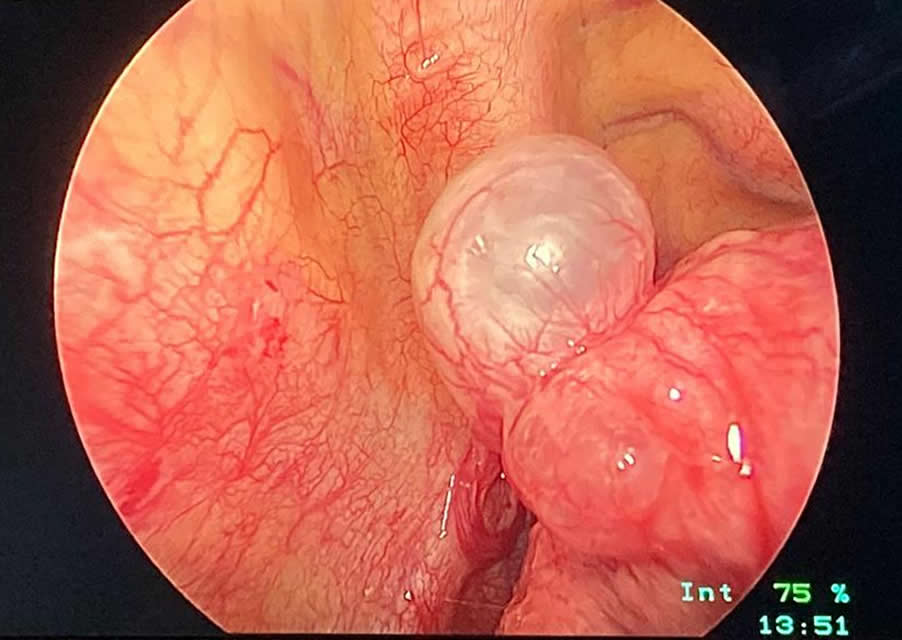 cirugía para bullas pulmonares