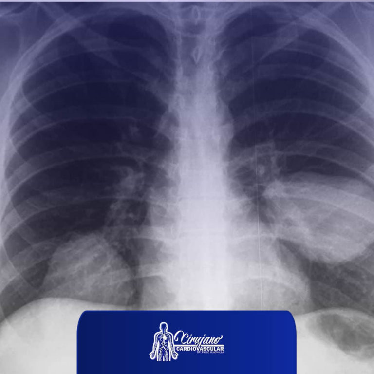 cirugia especializada de quiste pulmonar