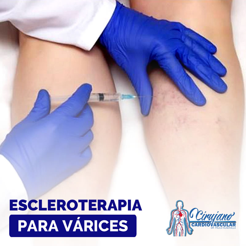 ¿En qué consiste la escleroterapia para tratar las várices?