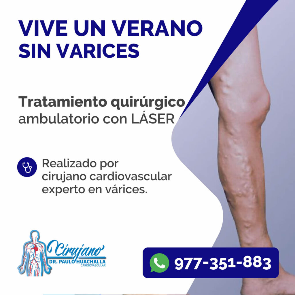 condensador Comida Oblongo Qué tratamientos existen para las várices en las piernas? - Cirujano  Cardiovascular