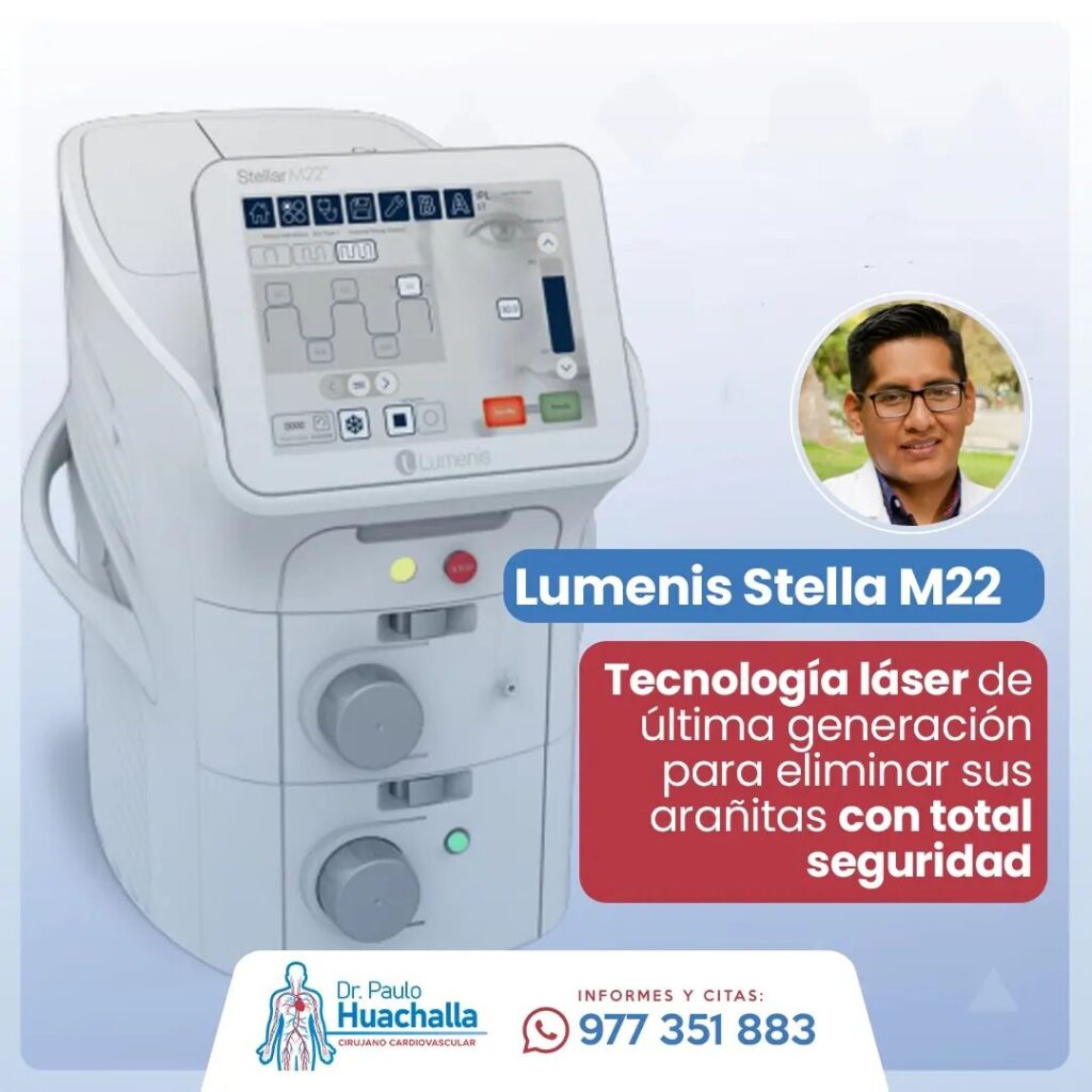 laser stella lumenis para tratar varices y arañitas vasculares