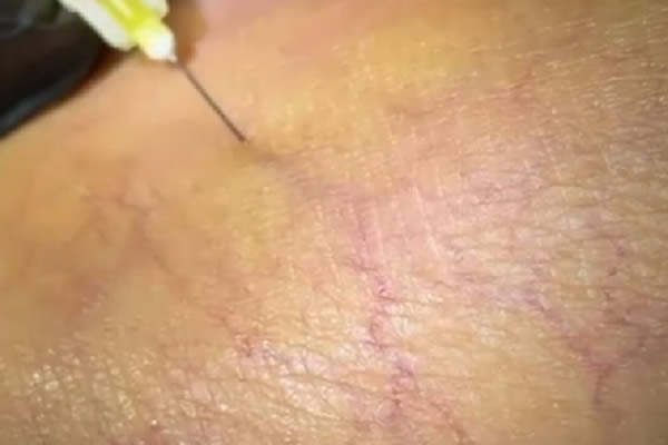 foto de varices superficiales aquí inyección para tratar telangiectasias