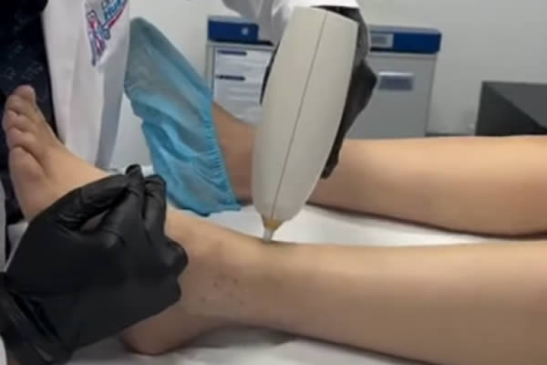 foto de laser tratando pierna con varices superficiales