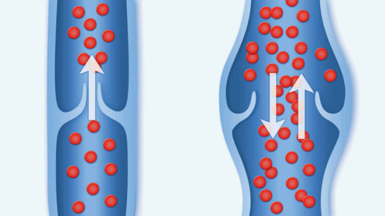 imagen de dos valvulas venosas una sana y otra con varices