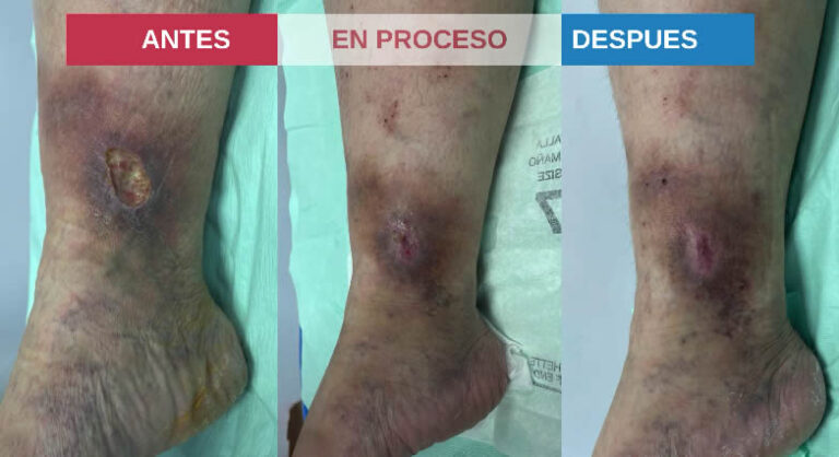 tratamiento de ulceras varicosas producto de varices