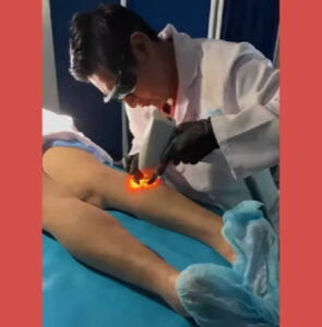 tratamiento de varices con clacs