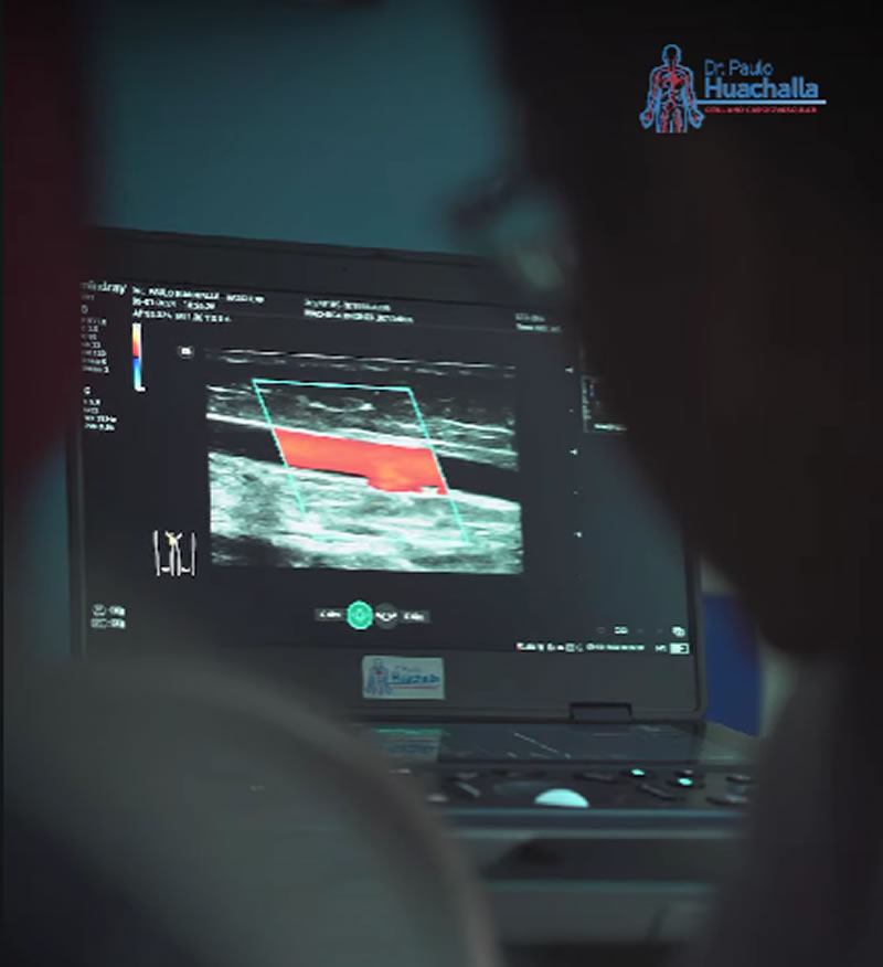 El Diagnóstico en Tratamientos de Várices: El Eco Doppler Venoso