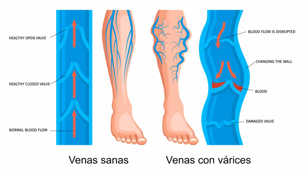 Muchas complicaciones en várices se producen por no tratarse con el especialista