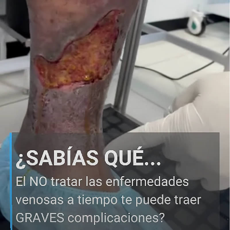 No tratar a tiempo las várices te puede traer graves complicaciones