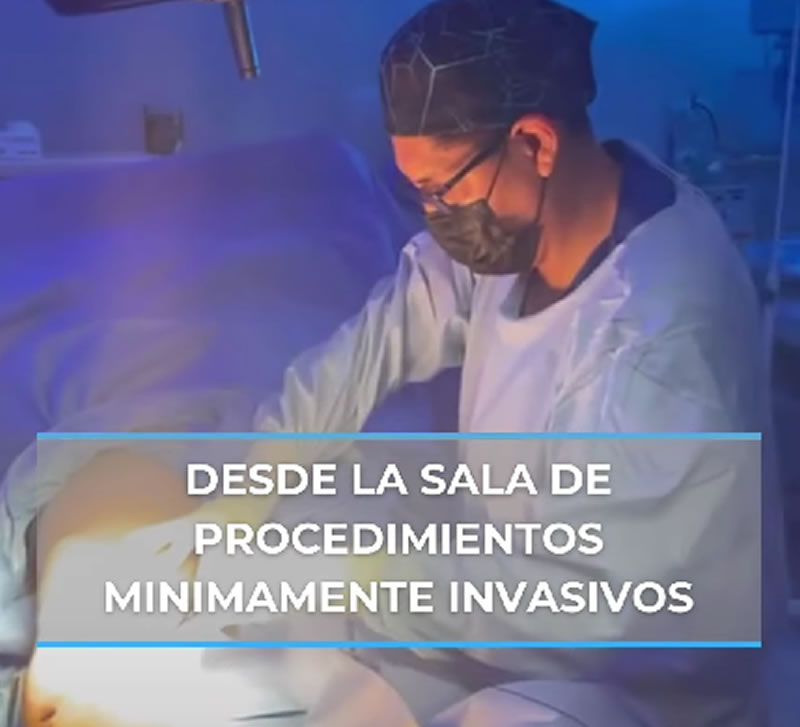 Tratamientos para Várices sin Dolor, Ablación Endovascular por Radiofrecuencia