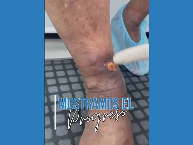 tratamiento de úlcera varicosa