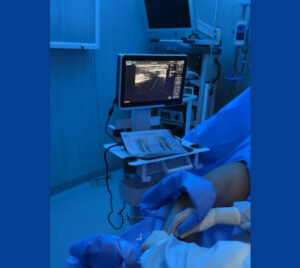 ablacion endovascular ecoguiada para várices