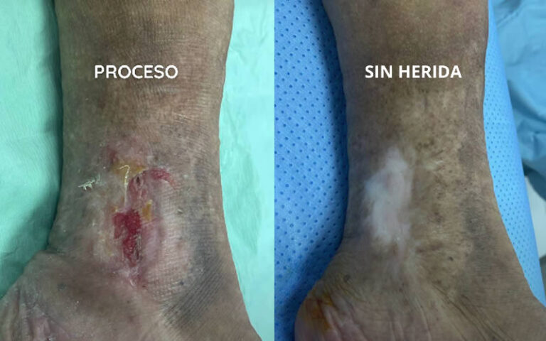 TRATAMIENTO DE ULCERAS VARICOSAS
