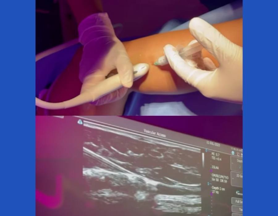 Tratamiento de Varices con EcoFoam