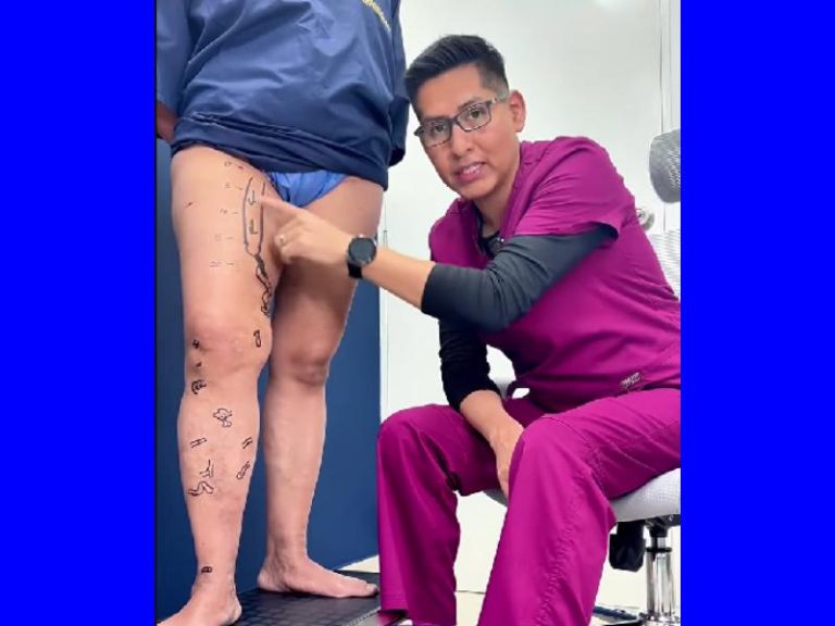 la importancia de identificar el origen de las varices