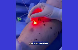 con el calor las várices se complican