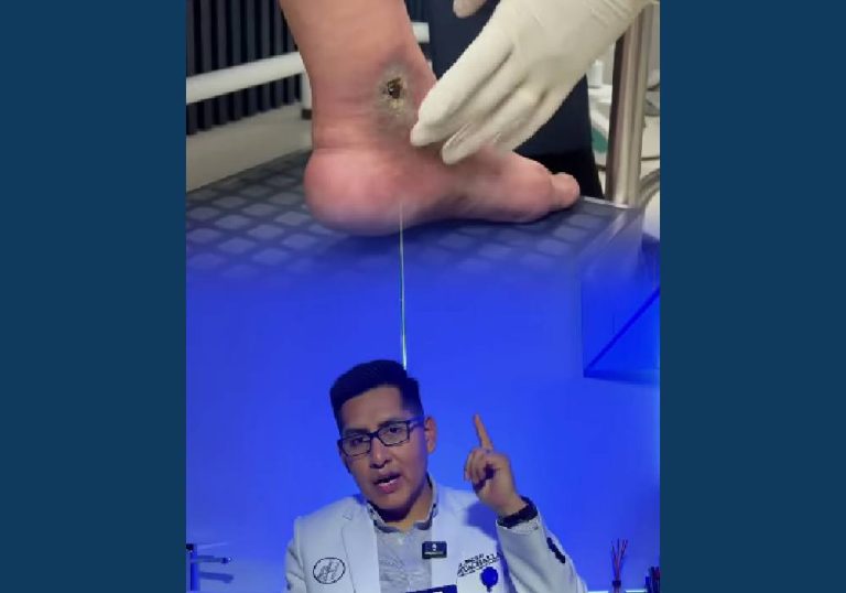 tienes una herida que no cierra, puede ser una ulcera varicosa