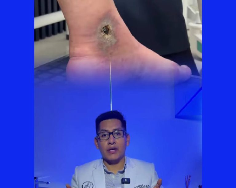 muchas heridas en las piernas no curan por las ulceras varicosas