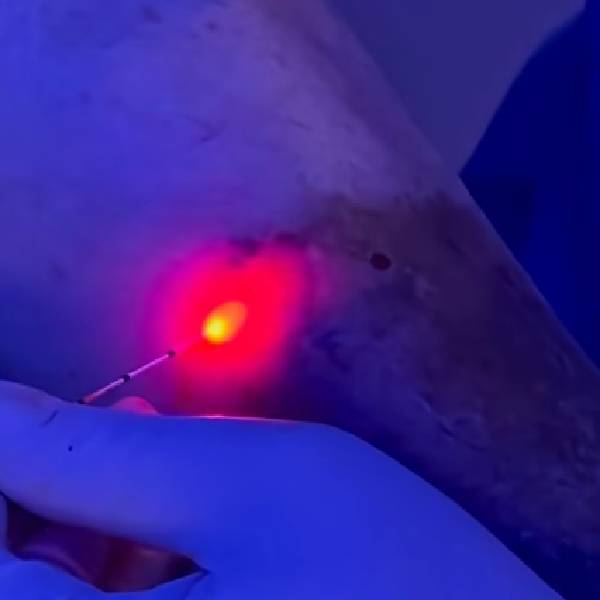 ablacion endovascular con laser