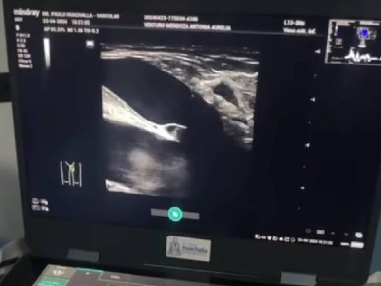 evaluacion con eco doppler venoso