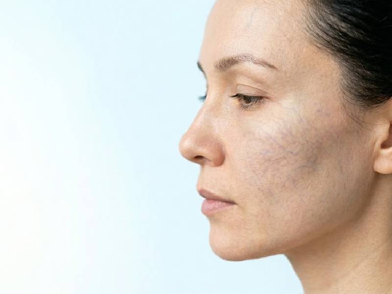 tratamiento estetico de venas faciales