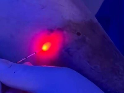 ablacion endovascular con laser