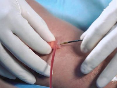 ablacion endovascular con radiofrecuencia