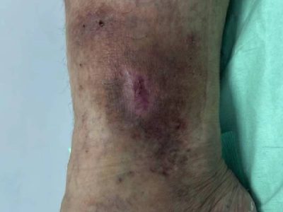 curacion de ulceras varicosas