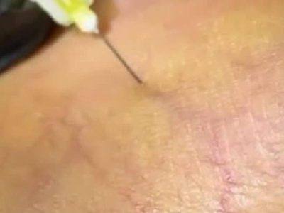 escleroterapia ampliada