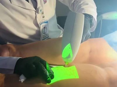 tratamiento clacs de arañitas vasculares
