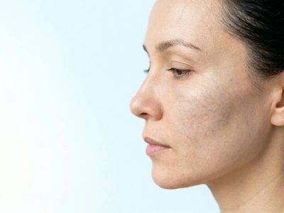 tratamiento estetico de venas faciales